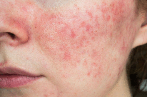 What Professional Options Exist for Rosacea Treatment