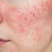 What Professional Options Exist for Rosacea Treatment