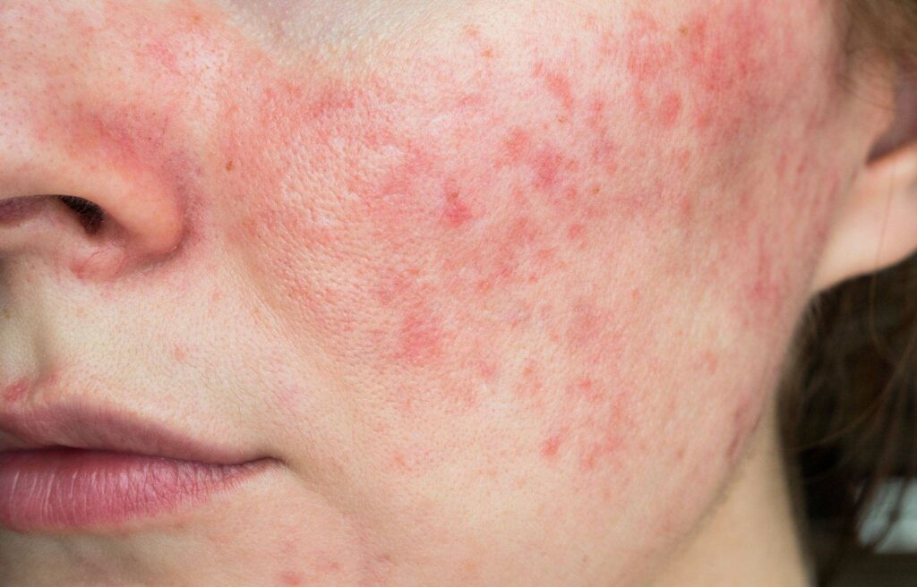 What Professional Options Exist for Rosacea Treatment